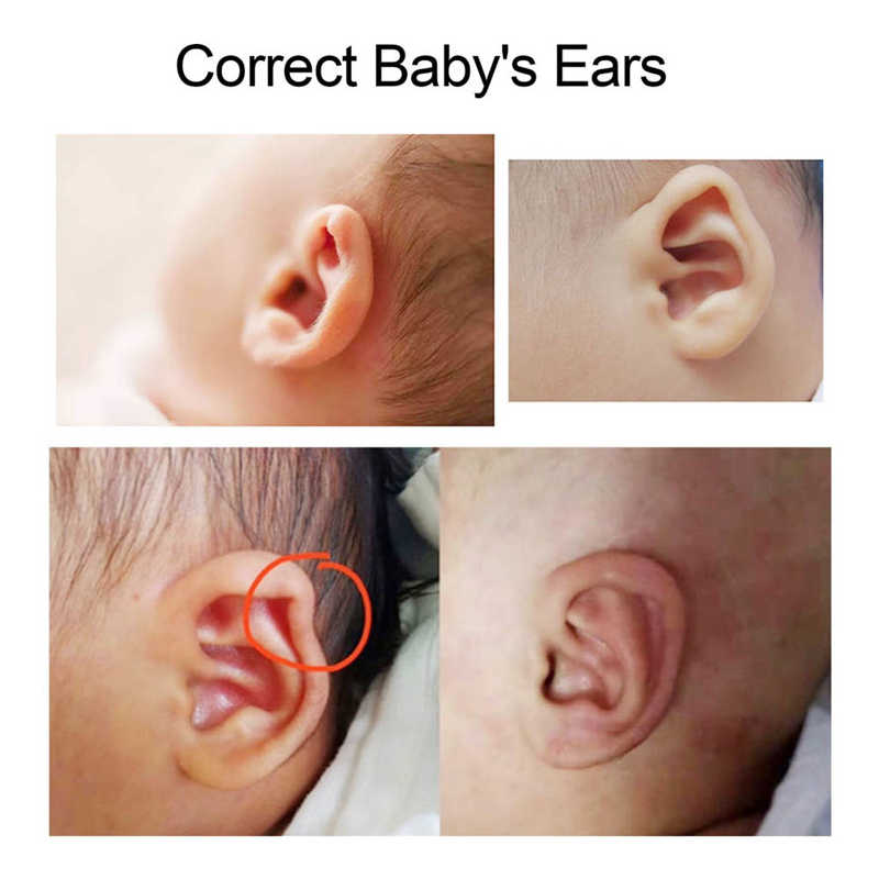 Silicone Baby Ear Correctors Sticker